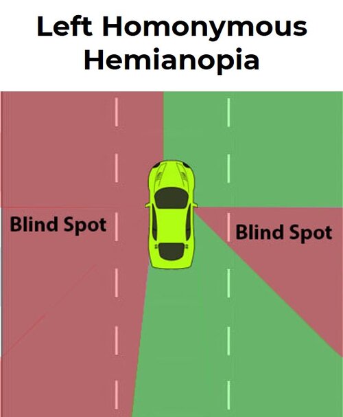 field of vision while driving for a person with left homonymous hemianopia field of vision while driving for a person with left homonymous hemianopia