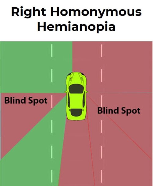 field of vision while driving for a person with right homonymous hemianopia field of vision while driving for a person with right homonymous hemianopia