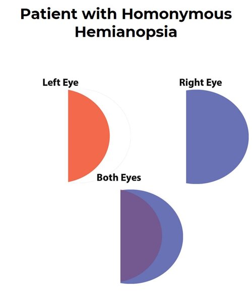 patient vision with homonymous hemianopsia patient vision with homonymous hemianopsia